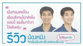 จัดฟันฟันล่างยื่นคร่อมฟันบนแบบไม่ผ่าตัด::แต่ก่อนเคยโดนเพื่อนล้อ แต่ตอนนี้ผมยิ้มกว้างๆได้แล้วครับ