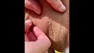 Popping 30 year old blackheads!