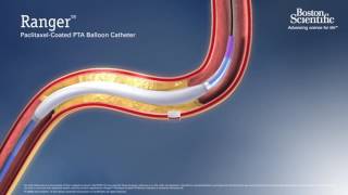 Drug eluting balloon