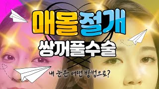 유연한 의사들 [쌍수 편] Ep3 나에게 적합한 쌍꺼풀수술은? 매몰? 절개?