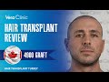 Vera Clinic Hair Transplant Turkey Review 4900 Grafts #hairtransplant #hairtransplantturkey