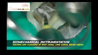 ONE VISIT ENDODONTIC treatment abscess big sinus tract bioceramic sealer ceramed