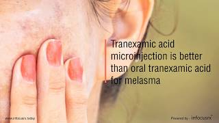 Tranexamic acid microinjection is better than oral tranexamic acid for melasma