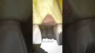 Bone Grafting Explained 🤔 Surgeon Reacts