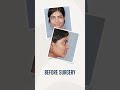 Rhinoplasty Amazing Results - Nose Surgery in Kerala | Dr Mathew PC #shorts