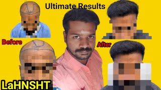 Subscriber's Results Ultimate Hair Growth High Density | Natural Looking good | LaHNS #LaHNS