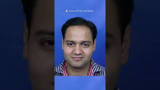 Hair Transplant Results in New Delhi | Before and After Surgery Results | 1886 Grafts Implants