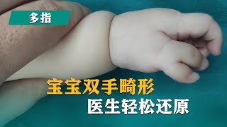 多指 | 宝宝双手畸形，医生轻松还原