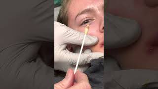 Draining of abscess from side of mouth