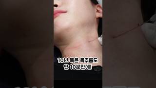 10년 묵은 가로목주름도 단 10분만에 지우기 #목주름지우개