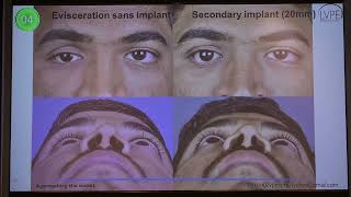 AIOC2022 GP123 topic Dr  TARJANI DAVE Socket Reconstruction   Assess and Address