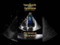 Apical Hypertrophic Cardiomyopathy (HCM) or Yamaguchi syndrome #echocardiography