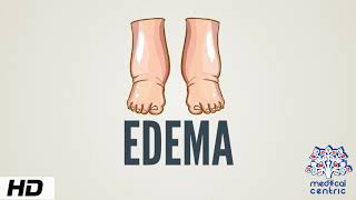 Edema, Causes, Signs and Symptoms, Diagnosis and Treatment.