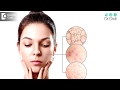 Is oily skin genetic? Is it more prone to acne? - Dr. Rasya Dixit | Doctors' Circle