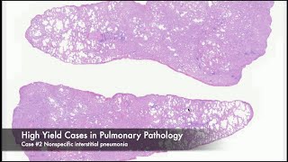 High Yield Pulmonary Case #2 Nonspecific interstitial pneumonia