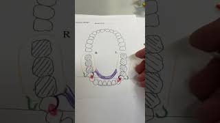 Partial Denture Design example