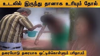 உடலில் இருந்து தானாக உரியும் தோல்..| சகோதர சகோதரியின் அவல நிலை.. - (01/11/2019)