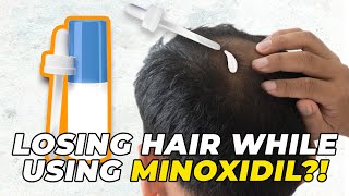 Still Losing Hair While Using Minoxidil? THIS IS WHY