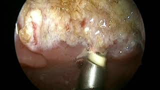 coblation adenoidectomy bloodless, painless, minimal recurrence