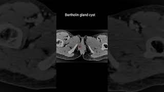 Bartholin gland cyst #ctabdomen