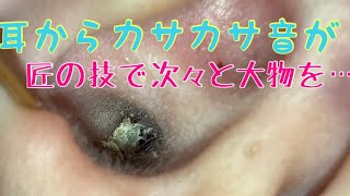 【匠の技】【耳かき】痒すぎる張り付く耳垢【EARWAX】