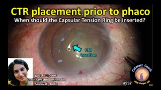 CTR capsular tension ring placement in cataract surgery