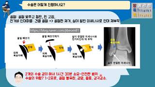 {발톡!}, 5중족골 근위부골절과 동반된 전거비인대 손상의 수술적치료