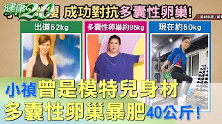 小禎曾是模特兒身材 多囊性卵巢暴肥40公斤！ 健康2.0