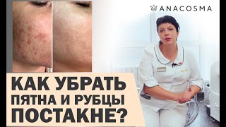 ПОСТАКНЕ 🔥 КАК УБРАТЬ ПЯТНА И РУБЦЫ ПОСЛЕ ВЫСЫПАНИЙ? | Федоряченко Оксана