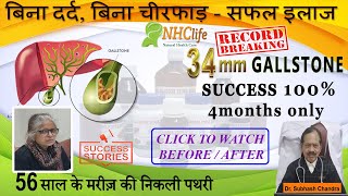 34mm GALLSTONE REMOVAL WITHOUT SURGERY | RECORD BREAKING | TREATMENT WITHOUT PAIN - Dr. S C Sharma