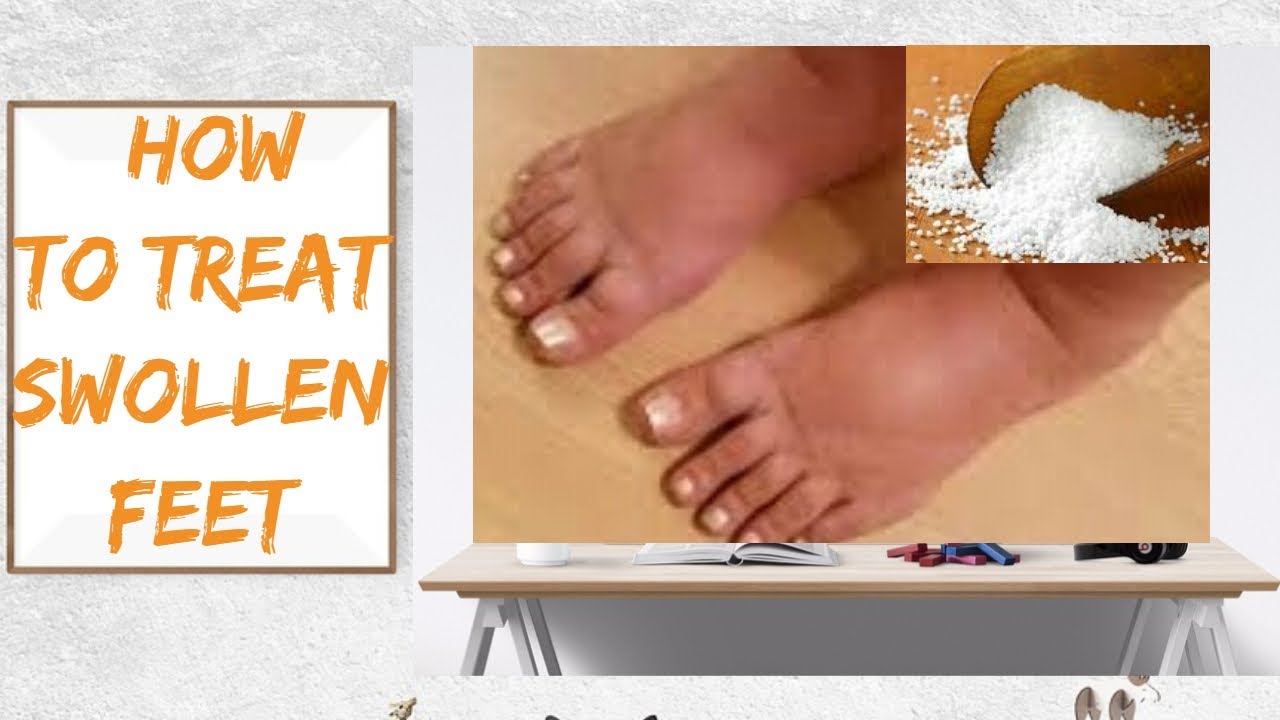 Swollen Feet, Effective Remedies To Treat Swollen Feet At Home. - YouTube