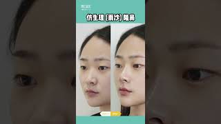 仿生理（雨沙）假體隆鼻 鼻整形 #隆鼻 #隆鼻手術 #鼻整形 #rhinoplasty