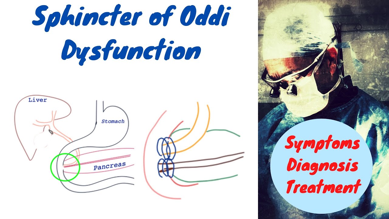 Sphincter Of Oddi Dysfunction; Made Easy To Understand - YouTube