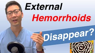 Can External hemorrhoids go away on their own? Does treatment matter?