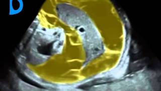 Fetal Medicine Foundation - Meconium peritonitis, 30 weeks