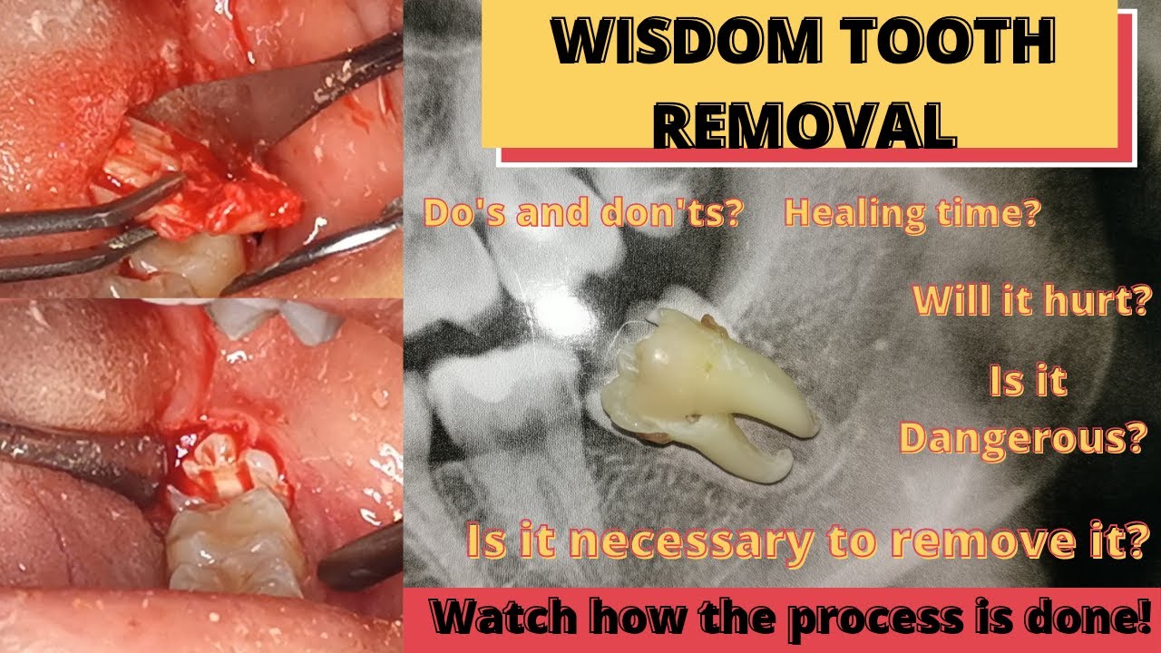 Wisdom Tooth Removal Process/surgery And All Things You Need To Know ...