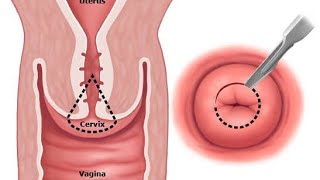 Cold knife conization;surgical procedure to remove cone shaped sectionof abnormal tissue from cervix