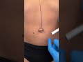 fixing an umbilical hernia