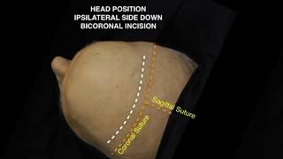 Anterior Interhemispheric Transcallosal Transchoroidal Approach