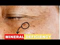 Lack Of this Mineral is Causing Your Age Spots|Mineral Deficiency