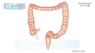 大腸憩室症／2分で分かる医療動画辞典　ミルメディカル