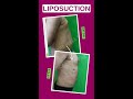 #shorts Liposuction - Before and After Results at Care Well Medical Centre