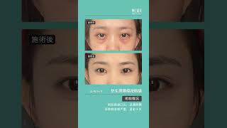 仿生理隱痕祛眼袋案例 #eyebag #eyebagremoval #眼袋內開 #眼袋手術