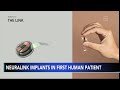 Neuralink implants brain chip in 1st human patient