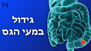 כריתת גידול במעי הגס בטכניקה זעיר-פולשנית | CUT מנתחים | הדסה טי וי