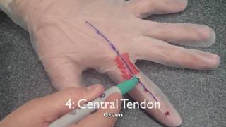 OT 440 Kinesiology: The Glove - Extensor Hood Mechanism