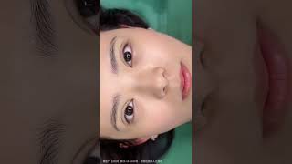 上海双眼皮全切手术审美设计 #医美 #doubleeyelidsurgery #双眼皮 #doubleeyelid #整形 #整形美容