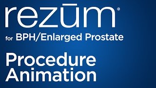 Rezūm for BPH/Enlarged Prostate | New BPH Treatment from Urology San Antonio