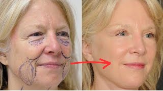 SMILE LINES (LAUGH LINES) REMOVAL AND FILL WITH KOREAN FACE EXERCISE & MASSAGE IN 2 WEEKS