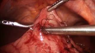 Laparoscopic intra-gastric resection - Dr. Julie Hallet